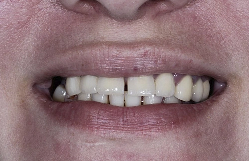 Одномоментная имплантация All-in-8 на верхней челюсти фото лечения