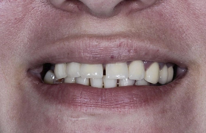 Фото работ - Одномоментная имплантация All-in-8 на верхней челюсти