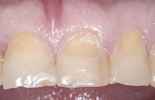 Восстановление формы зубов 1.1., 2.1, 2.2. в одно посещение - фото лечения в клинике ReSmile