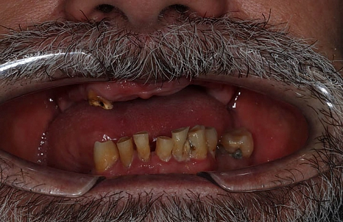 Комплексная реабилитация на верхней и нижней челюсти по системе Rеsmilе - фото работ