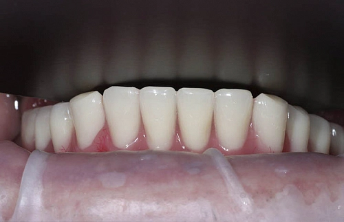 Восстановление жевательной функции и эстетики нижних зубов - фото лечения в клинике ReSmile