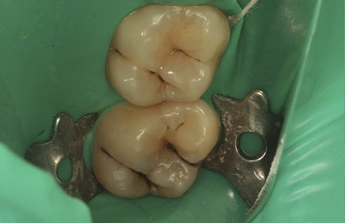 Лечение боли и восстановление анатомической формы зубов - фото лечения