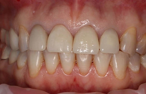 Исправление неудовлетворительного внешнего вида коронок и дефектов зубов  с помощью виниров и керамических коронок - фото лечения
