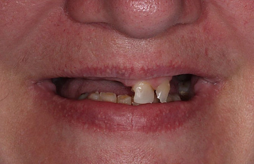 Восстановление зубов верхней и нижней челюсти