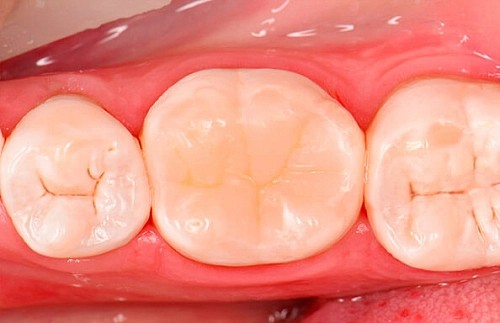 Лечение кариеса жевательного зуба - фото работ