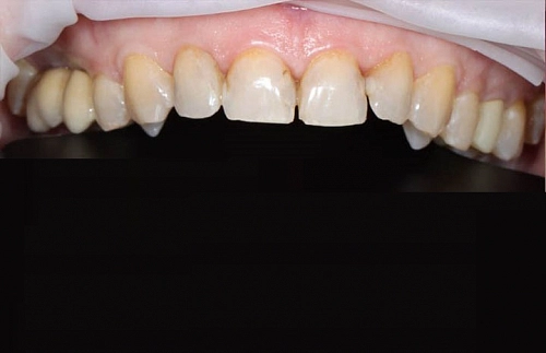 Установка виниров на 6 фронтальных зубов - фото лечения
