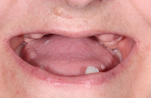 Решение проблемы отсутствия зубов у пациентки - фото лечения