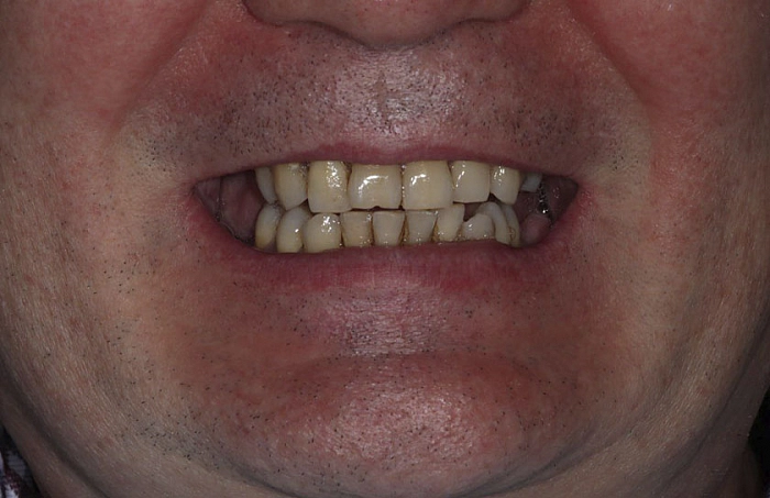 Фото работ - Лечение частичного отсутствия зубов на верхней и нижней челюсти