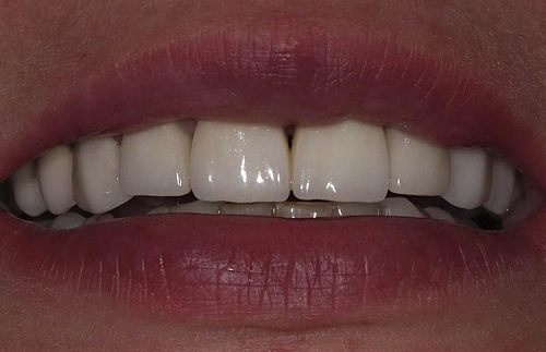 Замена старой коронки на циркониевую - фото лечения зубов