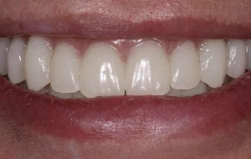 Решение проблемы пациента с отсутствующими зубами на верхней и нижней челюсти фото лечения