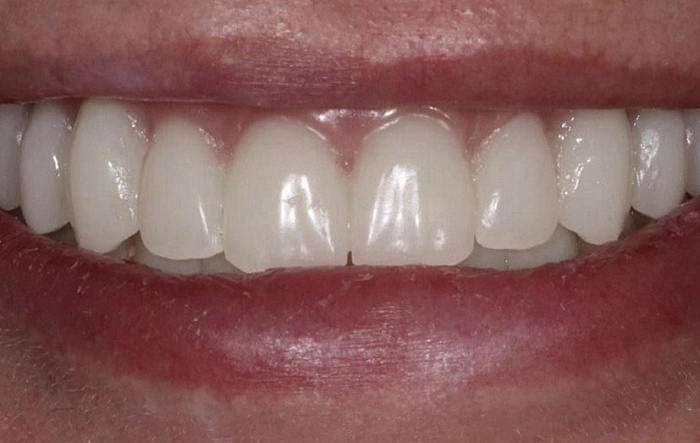 Фото работ - Решение проблемы пациента с отсутствующими зубами на верхней и нижней челюсти