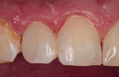 Лечение кариеса и восстановление формы зубов прямой реставрацией - фото лечения