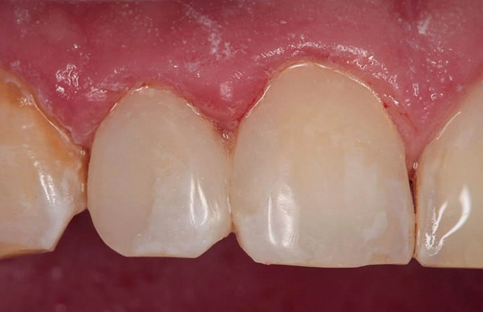 Фото работ - Лечение кариеса и восстановление формы зубов прямой реставрацией
