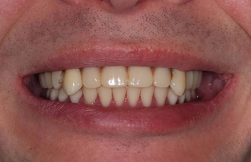 Решение проблемы пациента с отсутствующими зубами