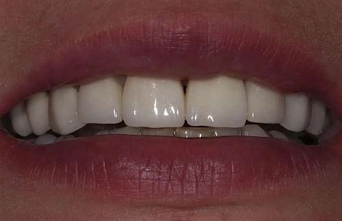 Замена старой зубной коронки на циркониевую коронку - фото лечения