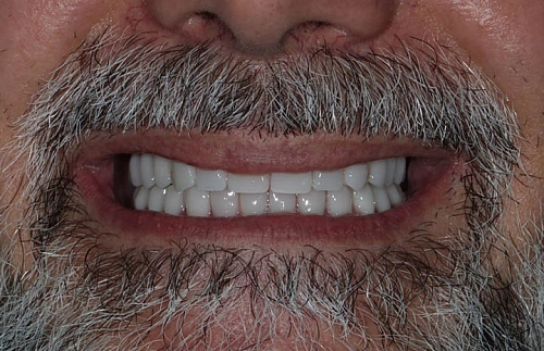 Комплексная реабилитация на верхней и нижней челюсти по системе Rеsmilе - фото работ