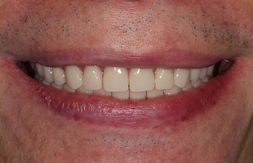 Решение проблемы с отсутствием зубов и восстановление эстетических дефектов