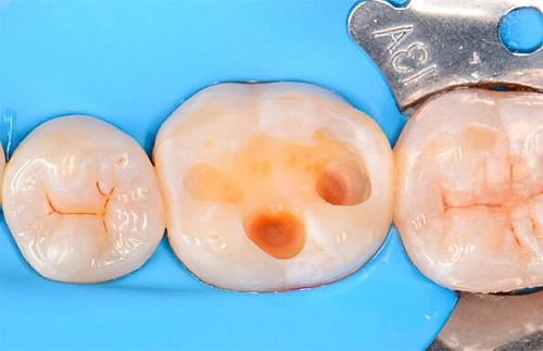 Восстановление зуба с помощью керамической вкладки - фото работ