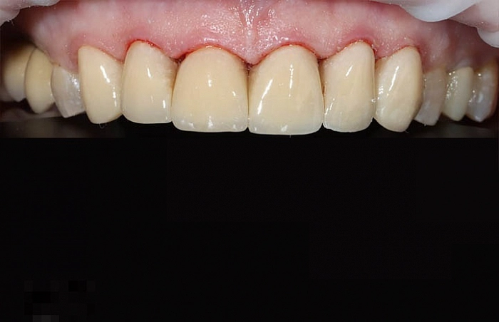Фото работ - Установка виниров на 6 фронтальных зубов