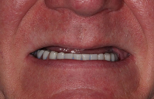 Решение проблемы отсутствия зубов на верхней челюсти фото работ