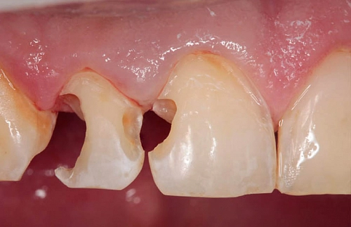 Лечение кариеса и восстановление формы зубов прямой реставрацией - фото лечения
