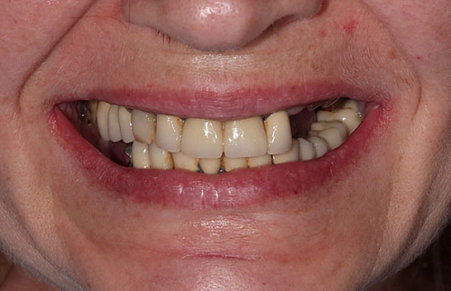 Решение проблемы отсутствия зубов на верхней и нижней челюсти фото работ