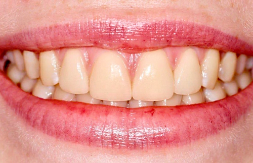Установка виниров на центральные зубы верхней челюсти
