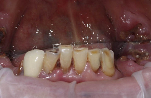 Восстановление жевательной функции и эстетики нижних зубов - фото лечения в клинике ReSmile