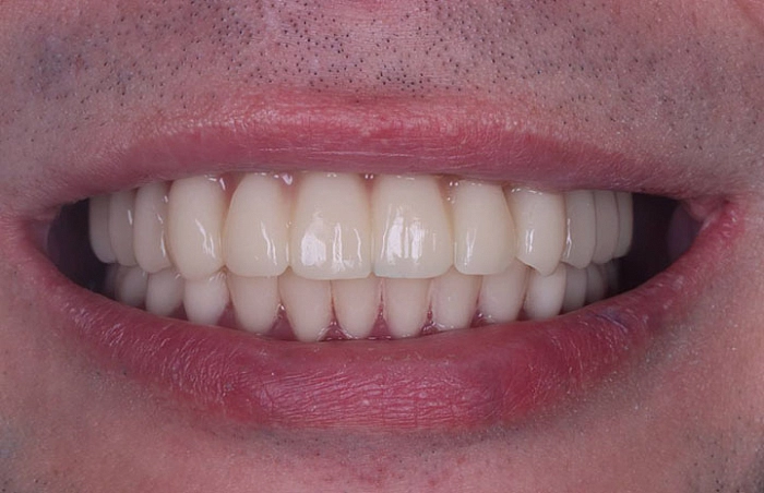 Фото работ - Решение проблемы пациента с отсутствующими зубами