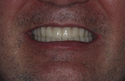 Лечение частичного отсутствия зубов на верхней и нижней челюсти - фото лечения