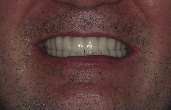 Фото работ - Лечение частичного отсутствия зубов на верхней и нижней челюсти