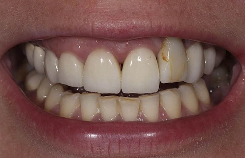 Замена старой коронки на циркониевую - фото лечения зубов