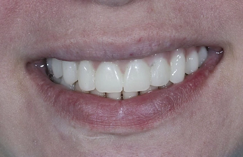 Одномоментная имплантация All-in-8 на верхней челюсти фото лечения
