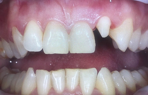 Восстановление зуба после получения травмы - фото лечения в клинике ReSmile