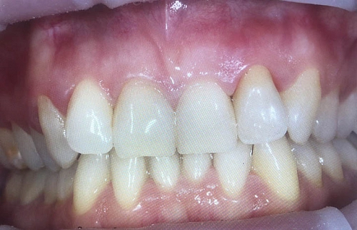 Восстановление зуба после получения травмы - фото лечения в клинике ReSmile