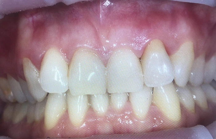 Фото работ - Восстановление зуба после получения травмы
