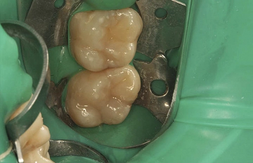 Лечение боли и восстановление анатомической формы зубов - фото лечения