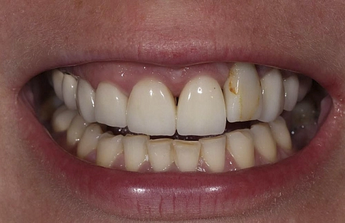 Замена старой зубной коронки на циркониевую коронку - фото лечения