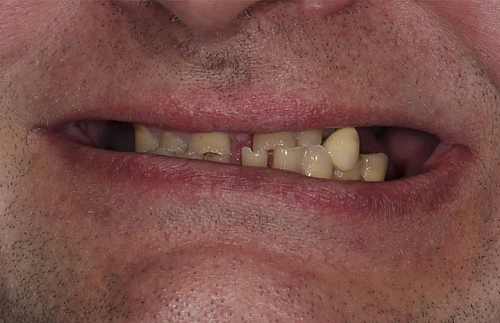 Решение проблемы с отсутствием зубов на верхней и нижней челюсти - фото работ
