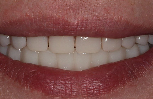 Одноэтапная имплантация All-in-6 на верхней и нижней челюсти фото лечения